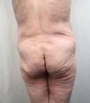 before lower body lift male patient back view case 4013