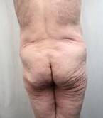 before lower body lift male patient back view case 4013