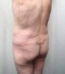 after lower body lift male patient left angle back view case 4013