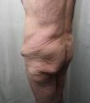 before lower body lift male patient left angle back view case 4013