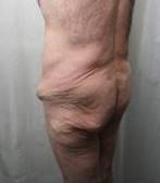 before lower body lift male patient left angle back view case 4013