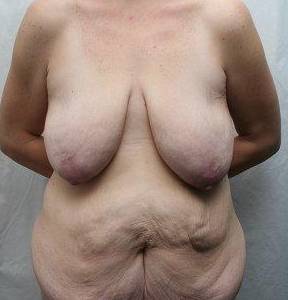 before lower body lift female patient front view case 4020