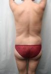 after lower body lift female patient back view case 4020