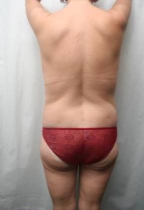 after lower body lift female patient back view case 4020