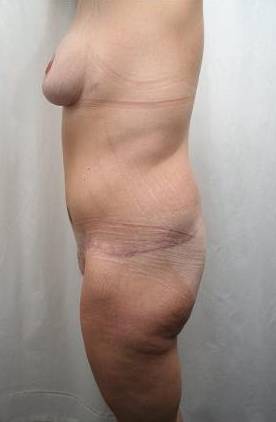 after lower body lift female patient left side view case 4020