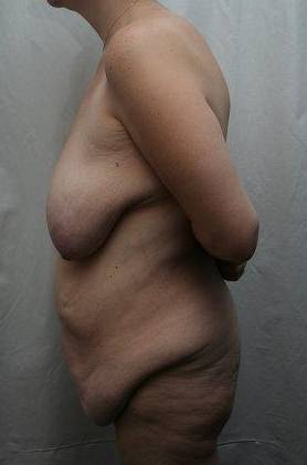 before lower body lift female patient left side view case 4020