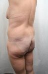 after lower body lift female patient left diagonal back view case 4020