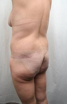 after lower body lift female patient left diagonal back view case 4020