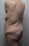 before lower body lift female patient left diagonal back view case 4020