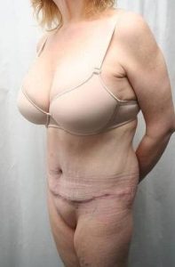 after lower body lift female patient left front diagonal view case 4029