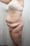 before lower body lift female patient front diagonal left view case 4029