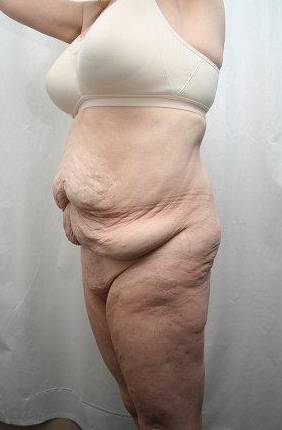 before lower body lift female patient front diagonal left view case 4029