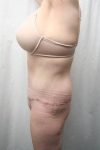after lower body lift female patient left side view case 4029