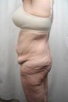 before lower body lift female patient left side view case 4029