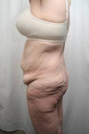 before lower body lift female patient left side view case 4029