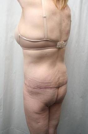 after lower body lift female patient left diagonal rear view case 4029