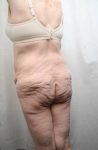 before lower body lift female patient left diagonal rear view case 4029