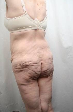 before lower body lift female patient left diagonal rear view case 4029