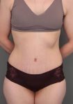 after lower body lift female patient front view case 4041