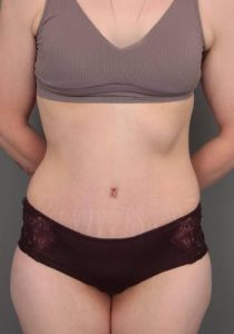 after lower body lift female patient front view case 4041