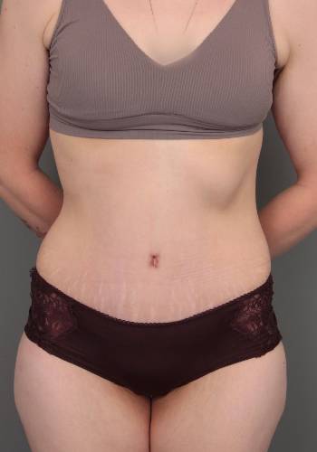 after lower body lift female patient front view case 4041