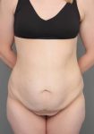 before lower body lift female patient front view case 4041