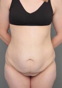 before lower body lift female patient front view case 4041