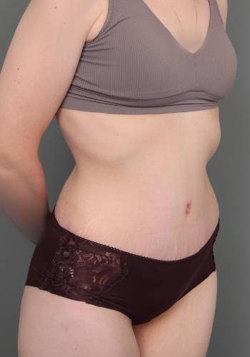 after lower body lift female patient right front diagonal view case 4041