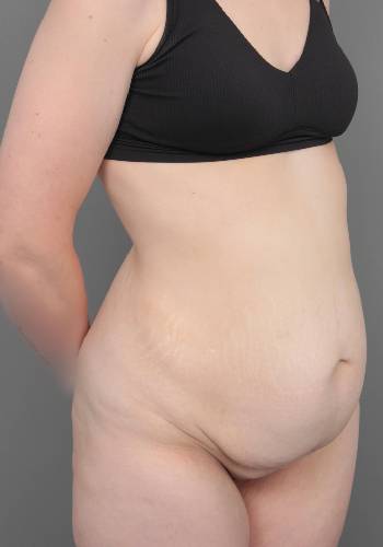 before lower body lift female patient right front diagonal view case 4041