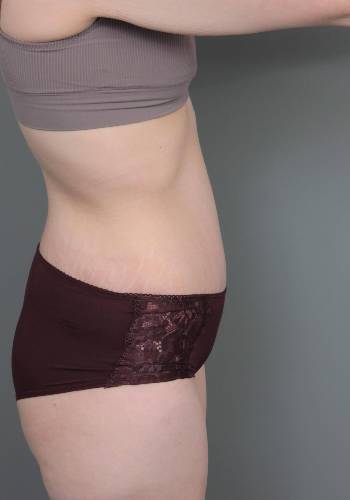 after lower body lift female patient right side view case 4041