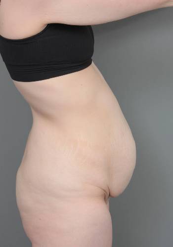 before lower body lift female patient right side view case 4041