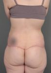after lower body lift female patient back view case 4041