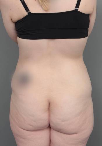 before lower body lift female patient back view case 4041