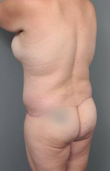 after lower body lift angle view case 4051
