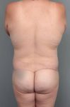 after lower body lift back view case 4051