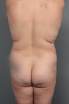 before lower body lift back view case 4051
