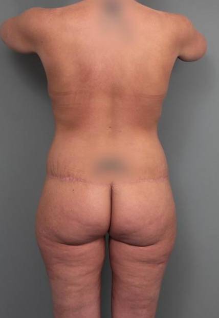 after lower body lift back view case 4092