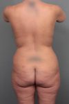 before lower body lift back view case 4092