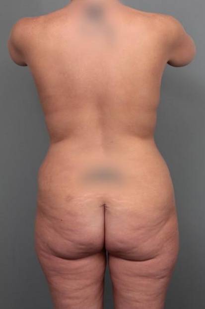 before lower body lift back view case 4092