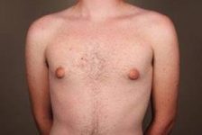 before male breast reduction front view case 4061
