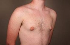 before male breast reduction angle view case 4061