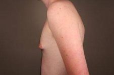 before male breast reduction side view case 4061