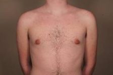 after male breast reduction front view case 4061