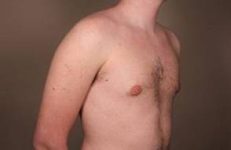 after male breast reduction angle view case 4061