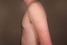 after male breast reduction side view case 4061