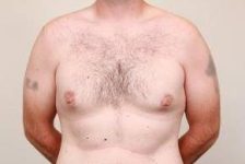 before male breast reduction front view case 4068