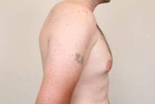 before male breast reduction side view case 4068