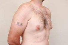before male breast reduction angle view case 4068