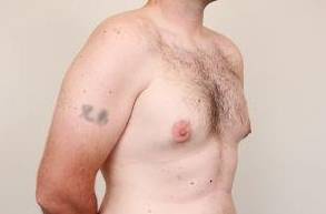 before male breast reduction angle view case 4068