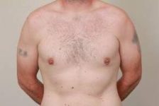 after male breast reduction front view case 4068